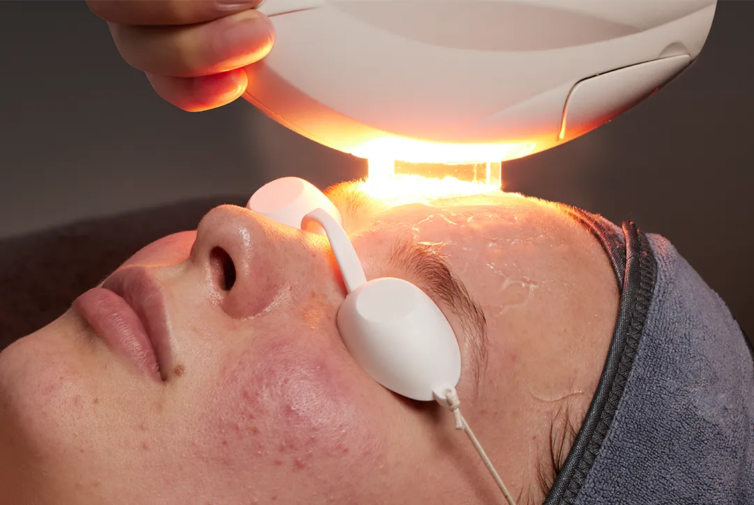 IPL Photofacial & Acne Solutions